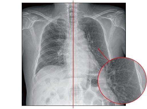 Smart Bone Suppression  